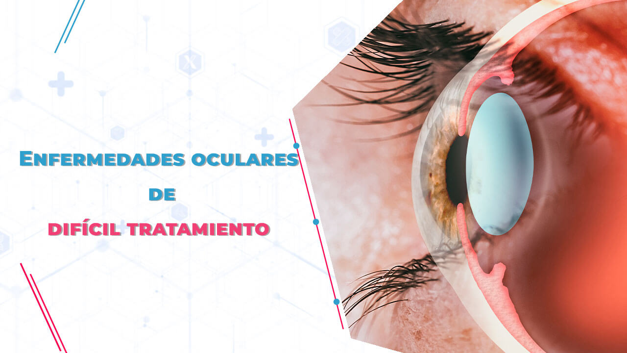 Enfermedades Oculares De Dif Cil Tratamiento